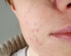 skin with the acne problems